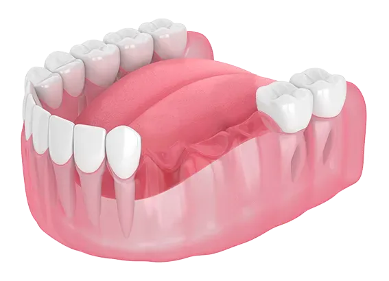Why Replacing a Missing Tooth Quickly Matters More Than Most Patients Realize